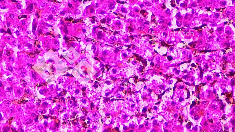 Imagen 4. Necrosis hepática focal con cuerpos de inclusión intranucleares anfofílicos ocasionales en la zona perinecrótica. Hígado.